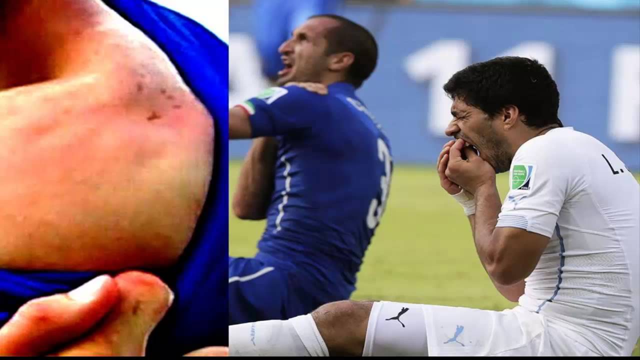 سواريز يتحدث لأول مرة عن عضة كيلليني